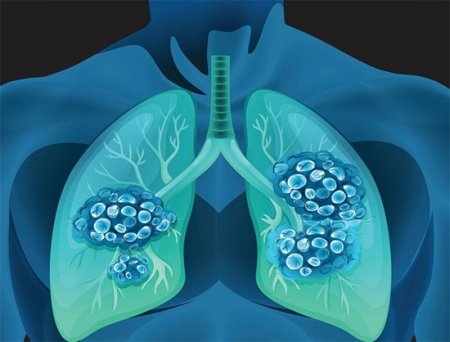 Lantern Pharma Gets Regulatory Approval to Expand Harmonic Clinical Trial for NSCLC